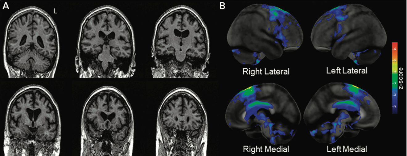 Imaging damage seen in a patient with PPAOS